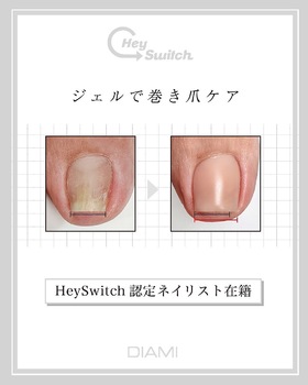 サンダル前に、巻き爪ケアしませんか？